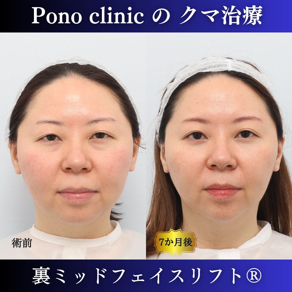 30代、目の下のクマ取り、裏ミッドフェイスリフト®