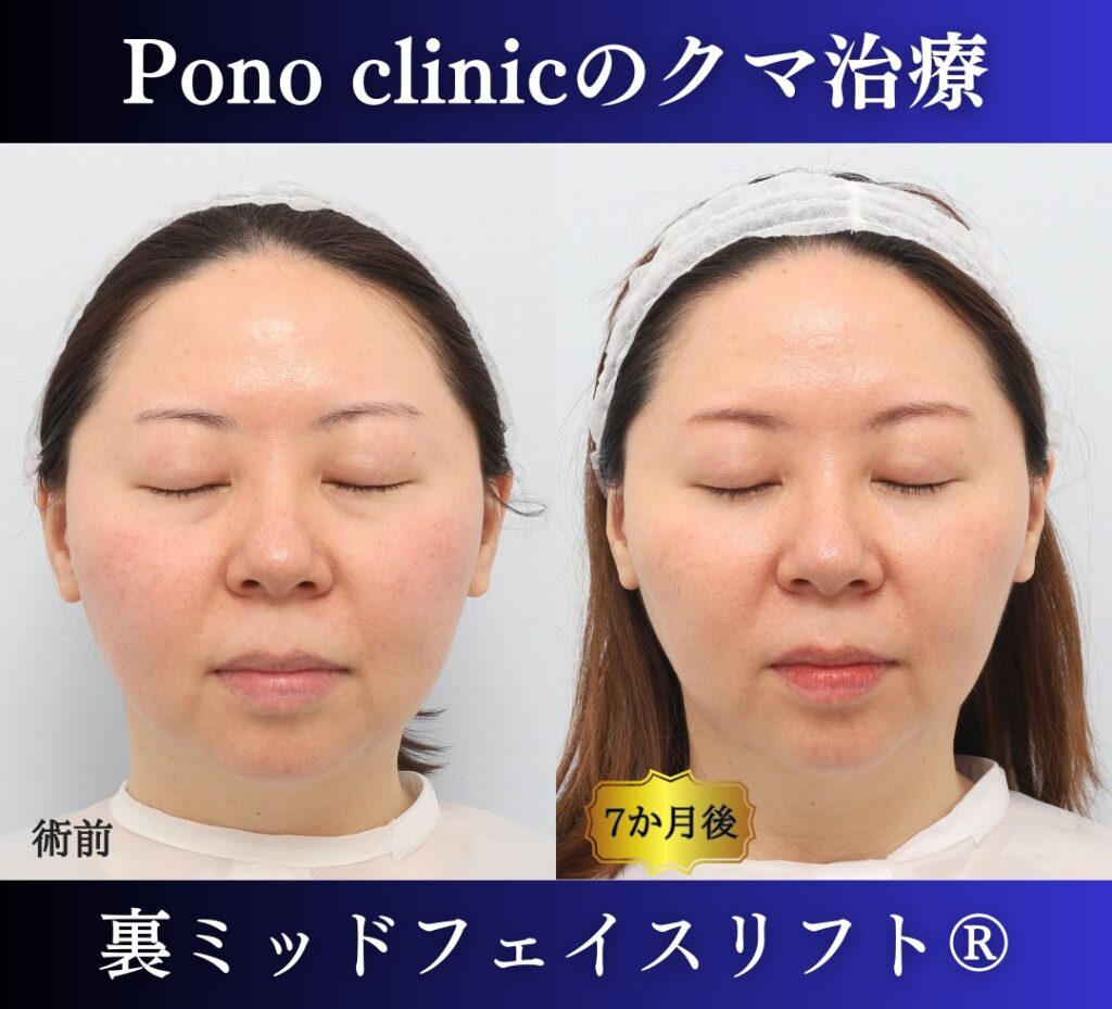 30代女性 裏ミッドフェイスリフト 閉眼時の術前と術後6か月の比較