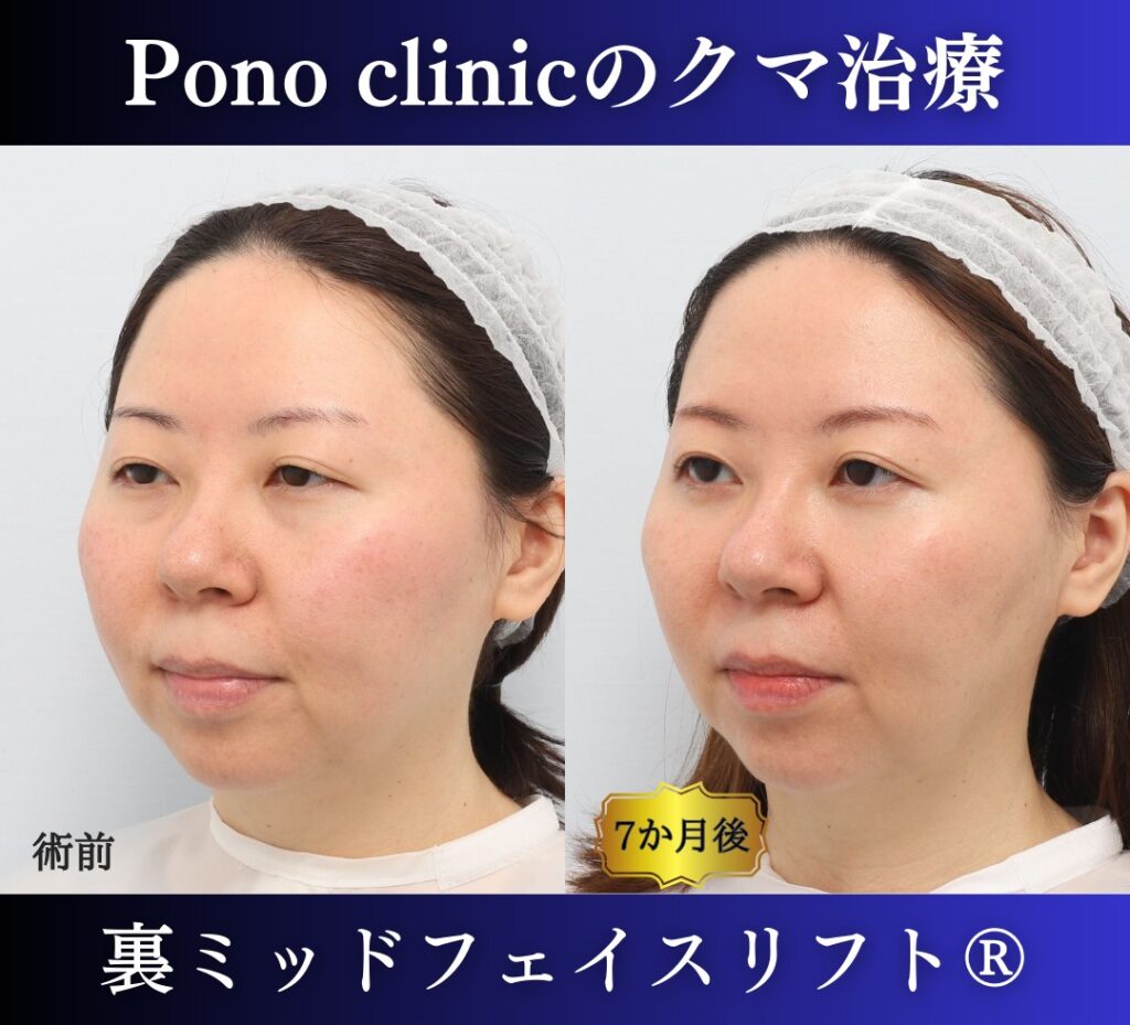 30代女性 裏ミッドフェイスリフト 左斜位の術前と術後6か月の比較