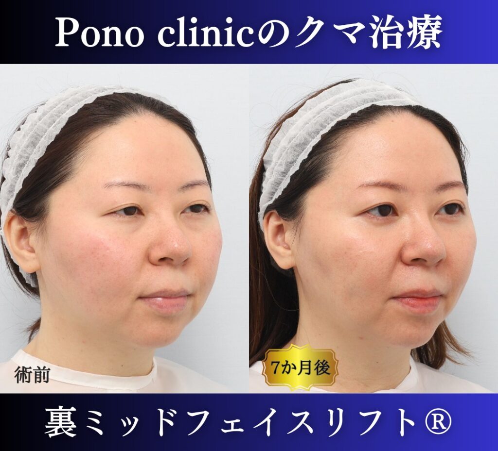 30代女性 裏ミッドフェイスリフト 右斜位の術前と術後6か月の比較