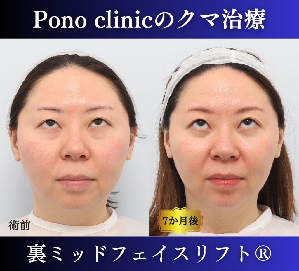 30代女性 裏ミッドフェイスリフト 上方視の術前と術後6か月の比較