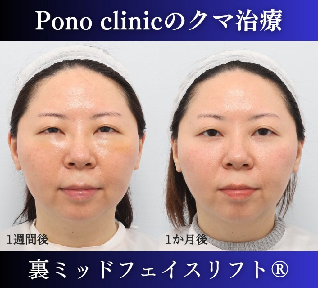 30代女性 裏ミッドフェイスリフト 術後1週間と術後1か月の経過