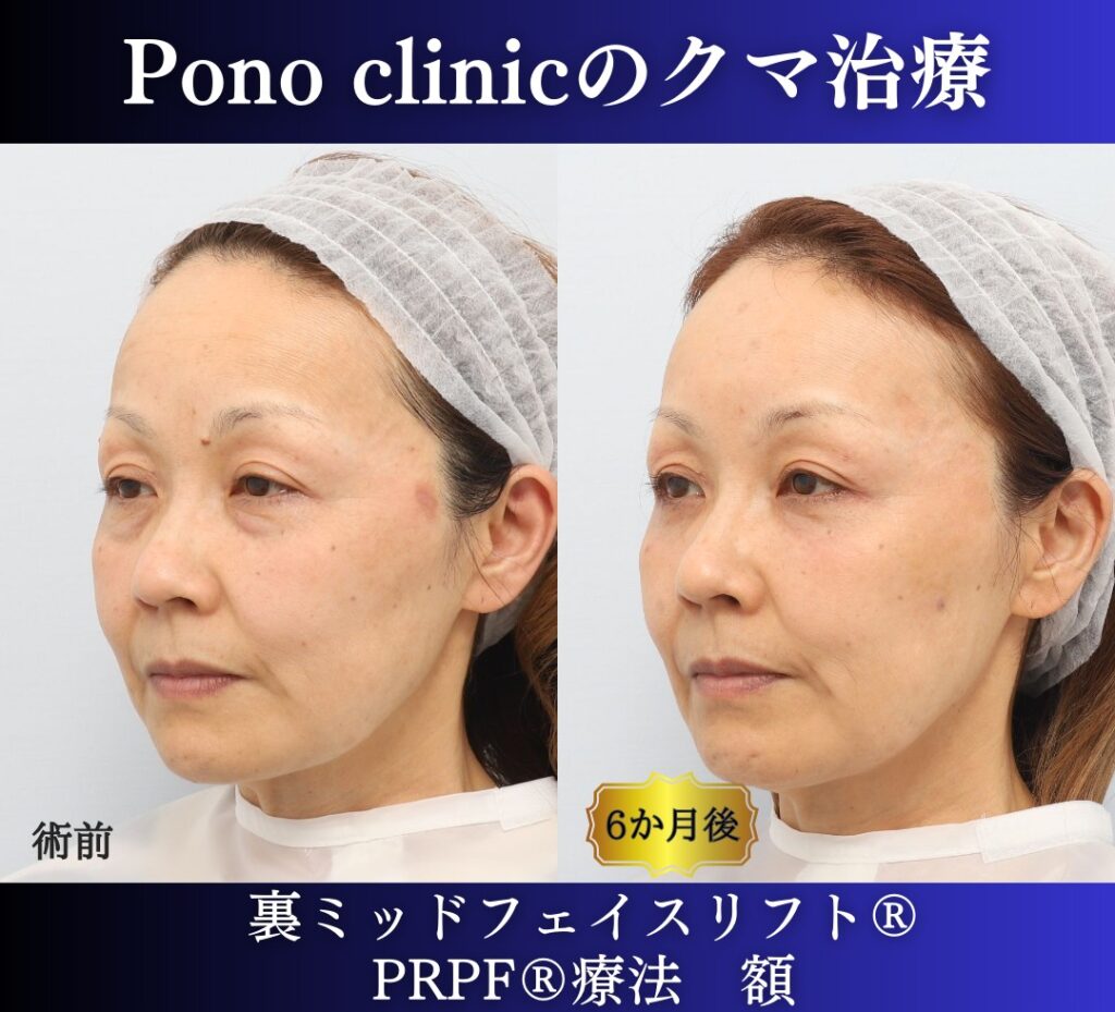50代女性、目の下のたるみ取りの治療、裏ミッドフェイスリフト (9)