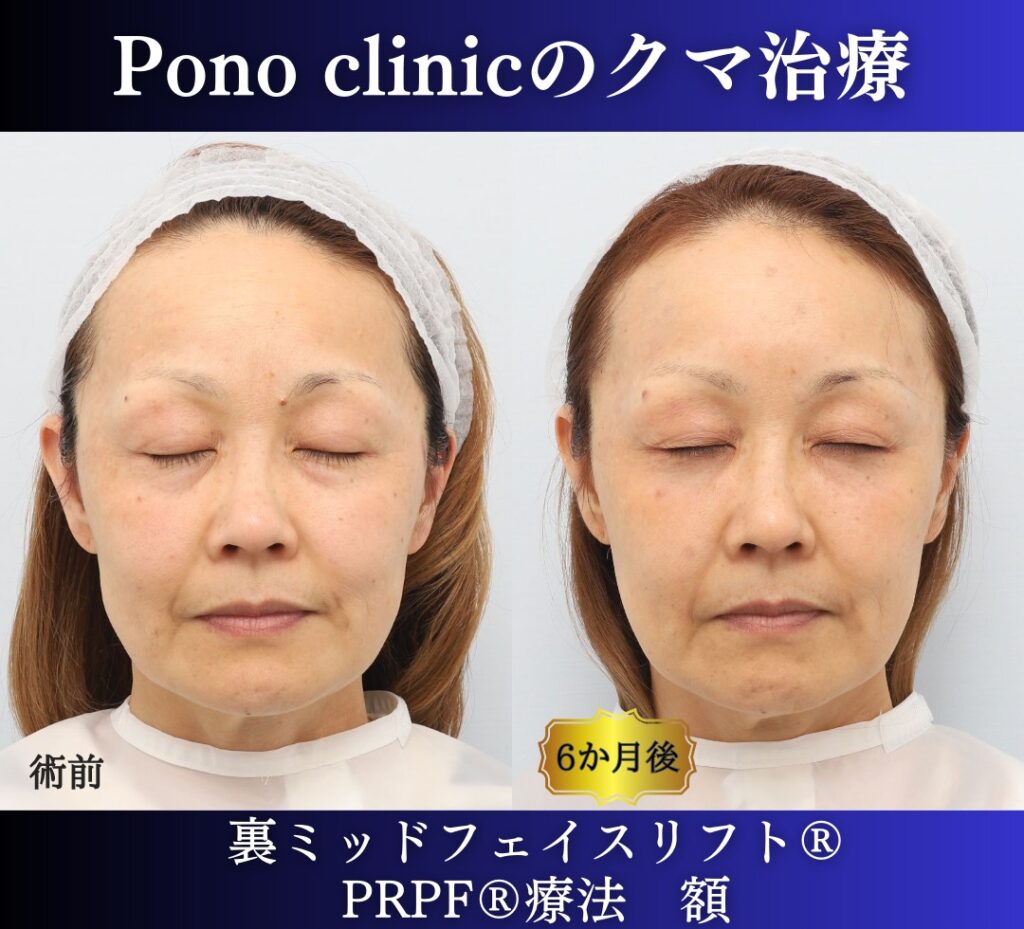 50代女性、目の下のたるみ取りの治療、裏ミッドフェイスリフト (12)