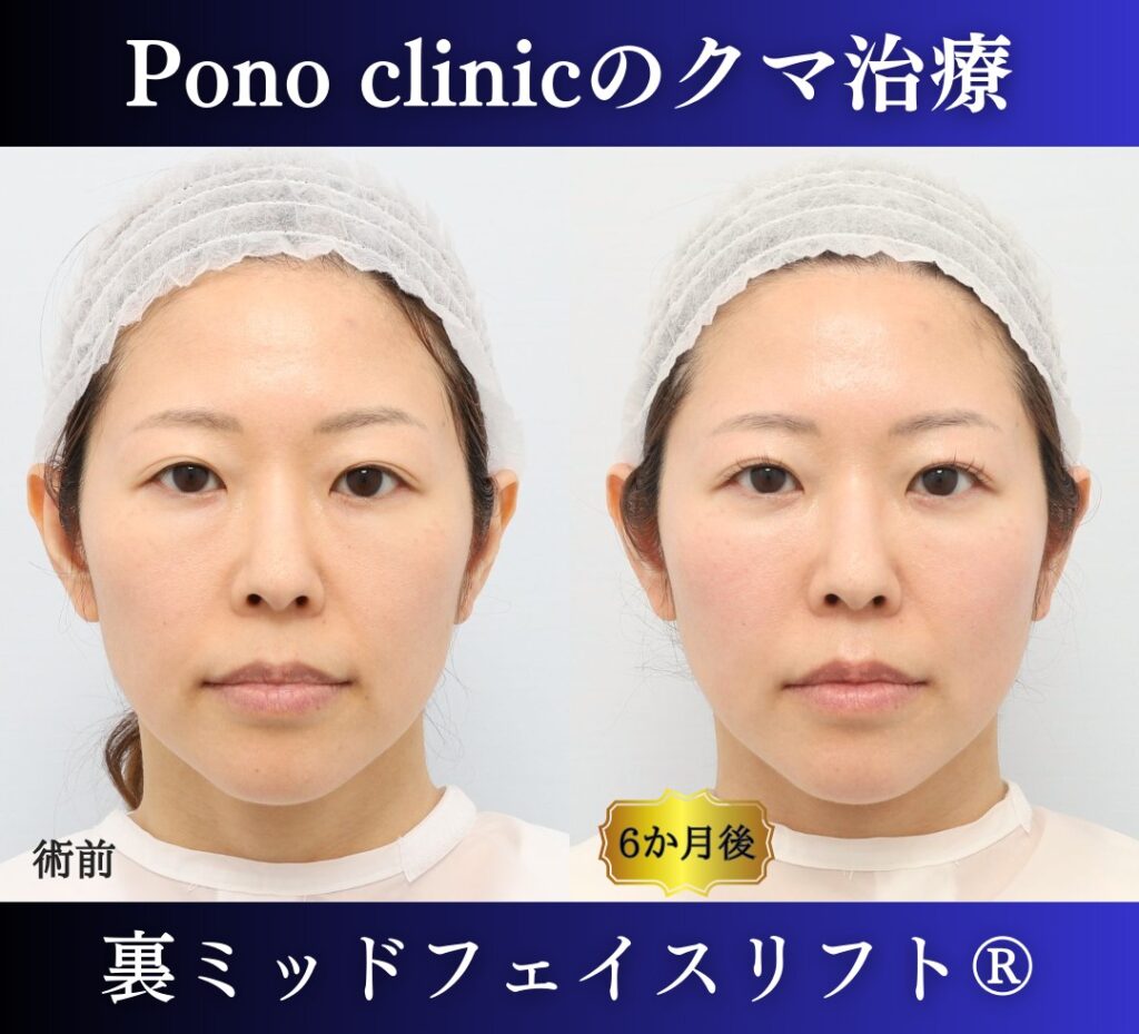 40代女性、目の下のクマ取り東京、裏ミッドフェイスリフト® の症例 (5)