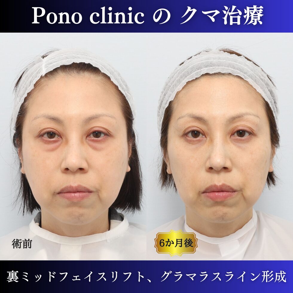 目の下のクマ取り、グラマラスライン形成、目尻切開の症例