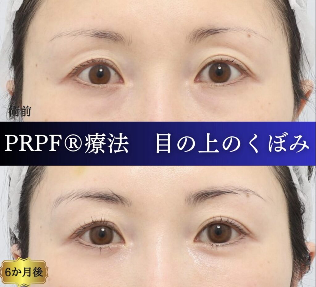 くぼみ目の治療、PRPF療法、40代女性の症例 (5)