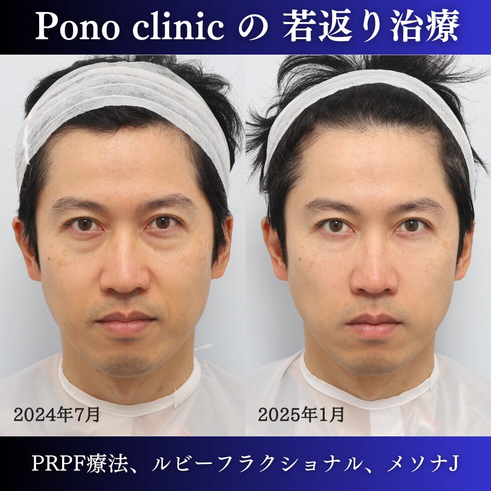 目の下のしわ、法令線、しわ治療、しみ、美白、美肌、40代男性の症例