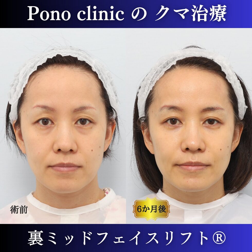 目の下のクマ取り、裏ミッドフェイスリフト、法令線治療、PRPF、40代女性の症例