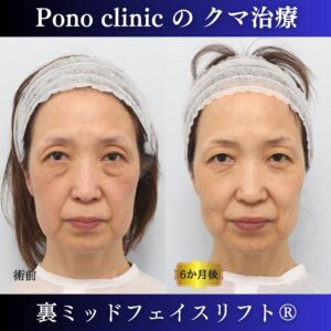 クマ取り東京、裏ミッドフェイスリフト、50代の症例