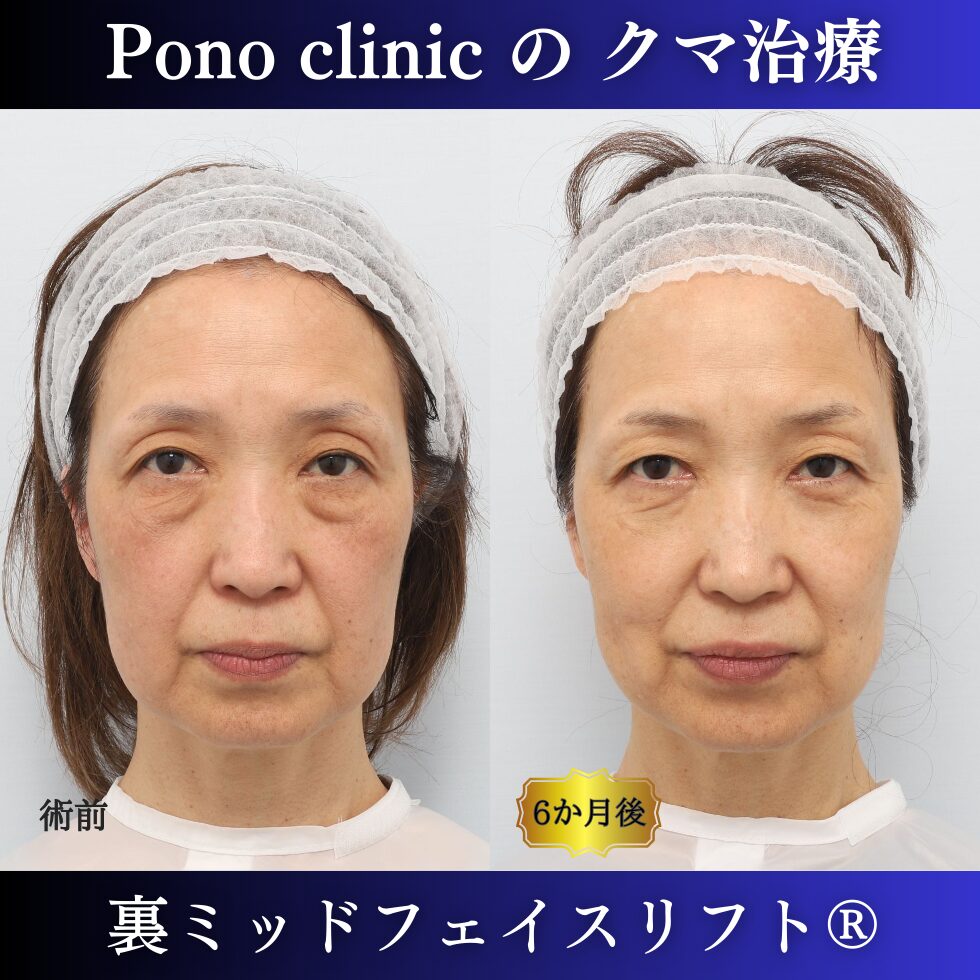 クマ取り東京、裏ミッドフェイスリフト、50代の症例