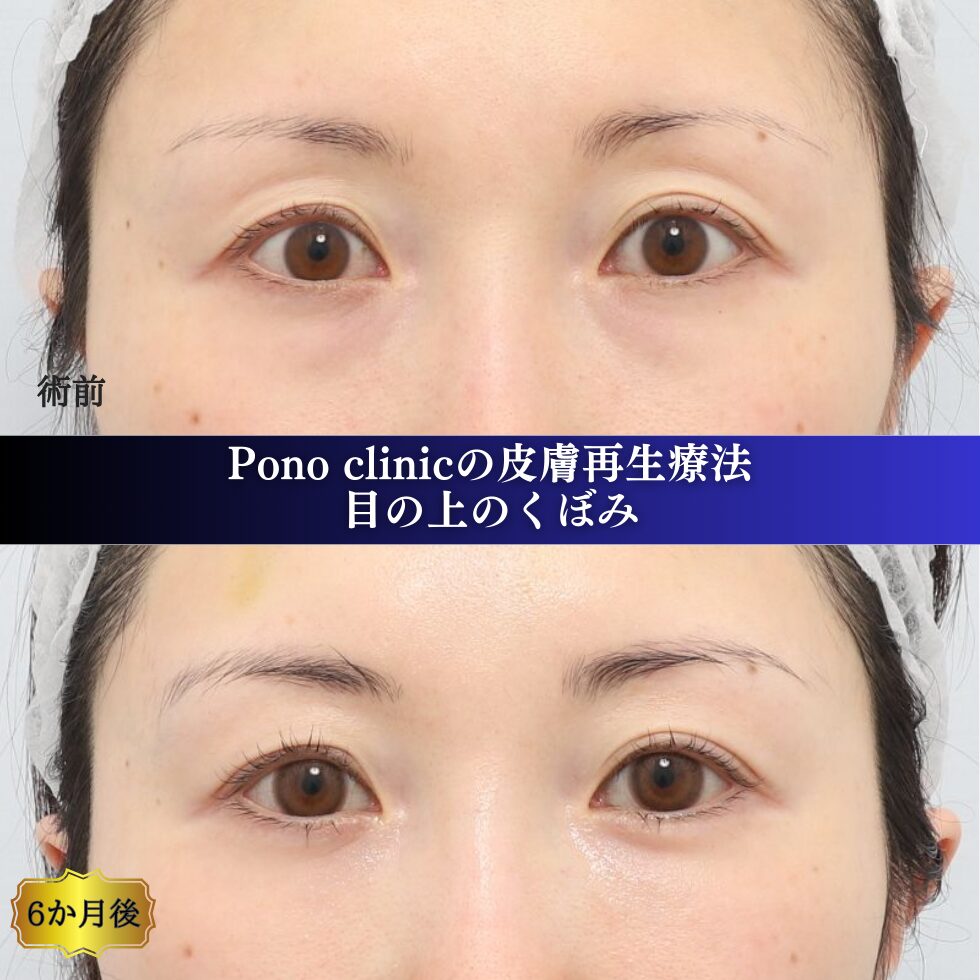 くぼみ目の治療、PRPF療法、目の上のへこみ、40代女性の症例