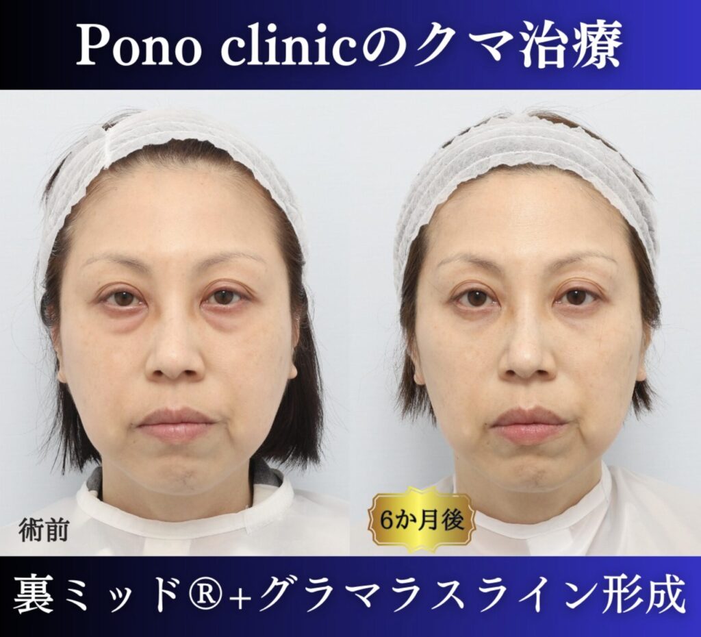 目の下のクマ取り、グラマラスライン形成、目尻切開の症例 (10)