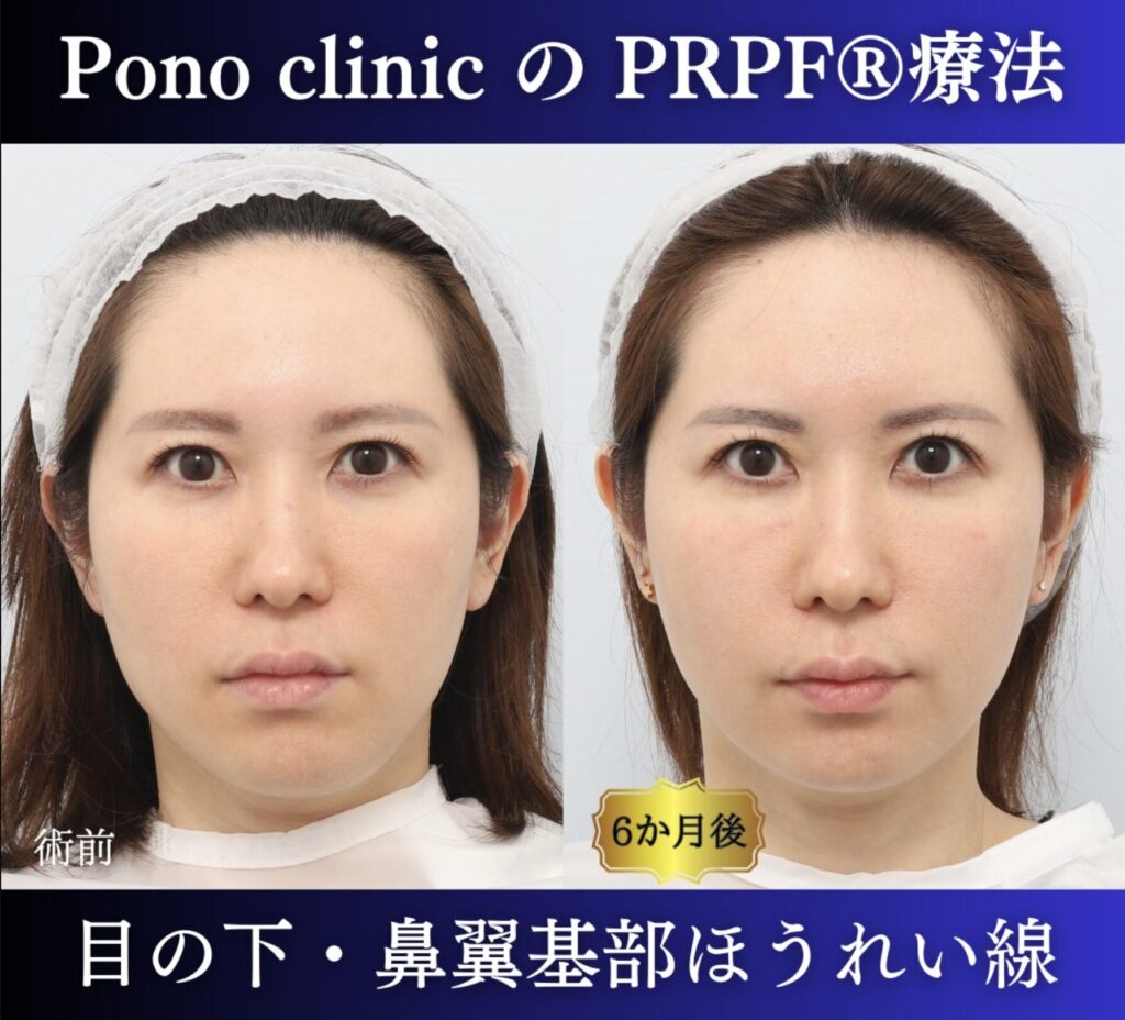 青クマ、法令線、鼻翼基部の凹み、PRPF®療法の症例 (3)