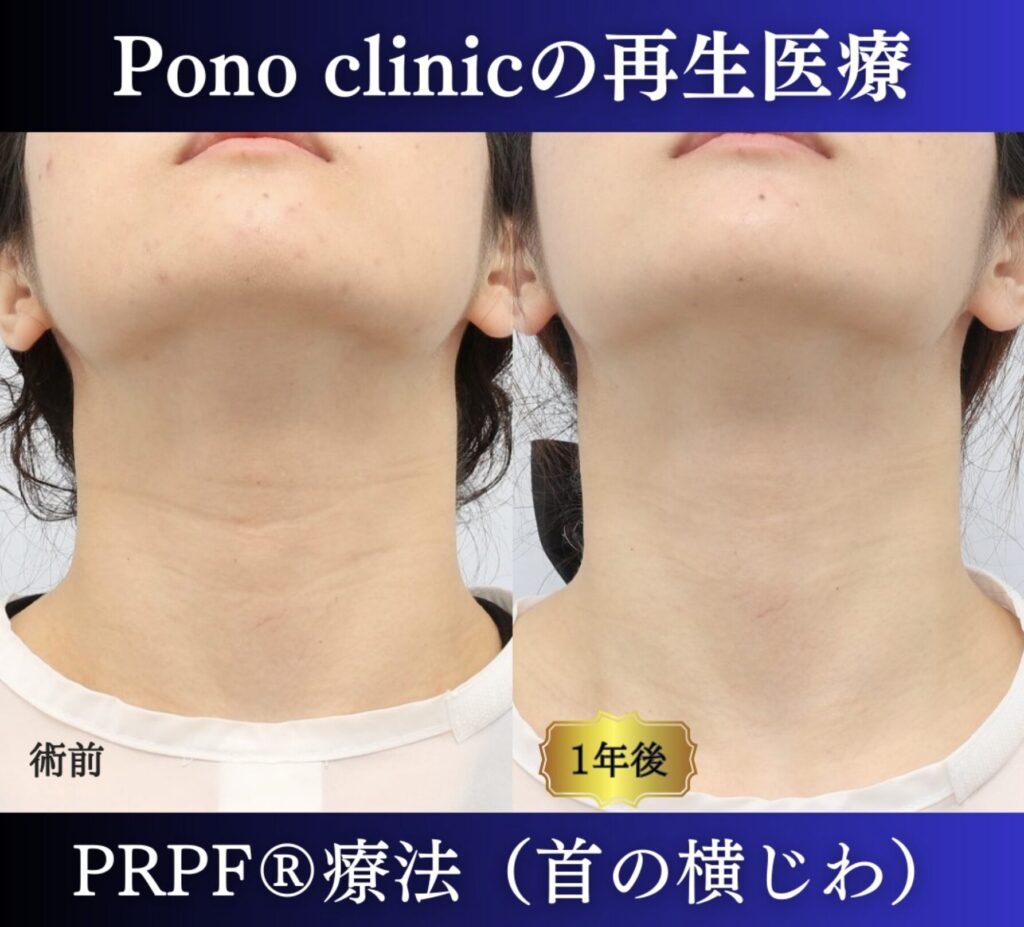 首のしわ、PRPF®療法の症例、20代 (4)
