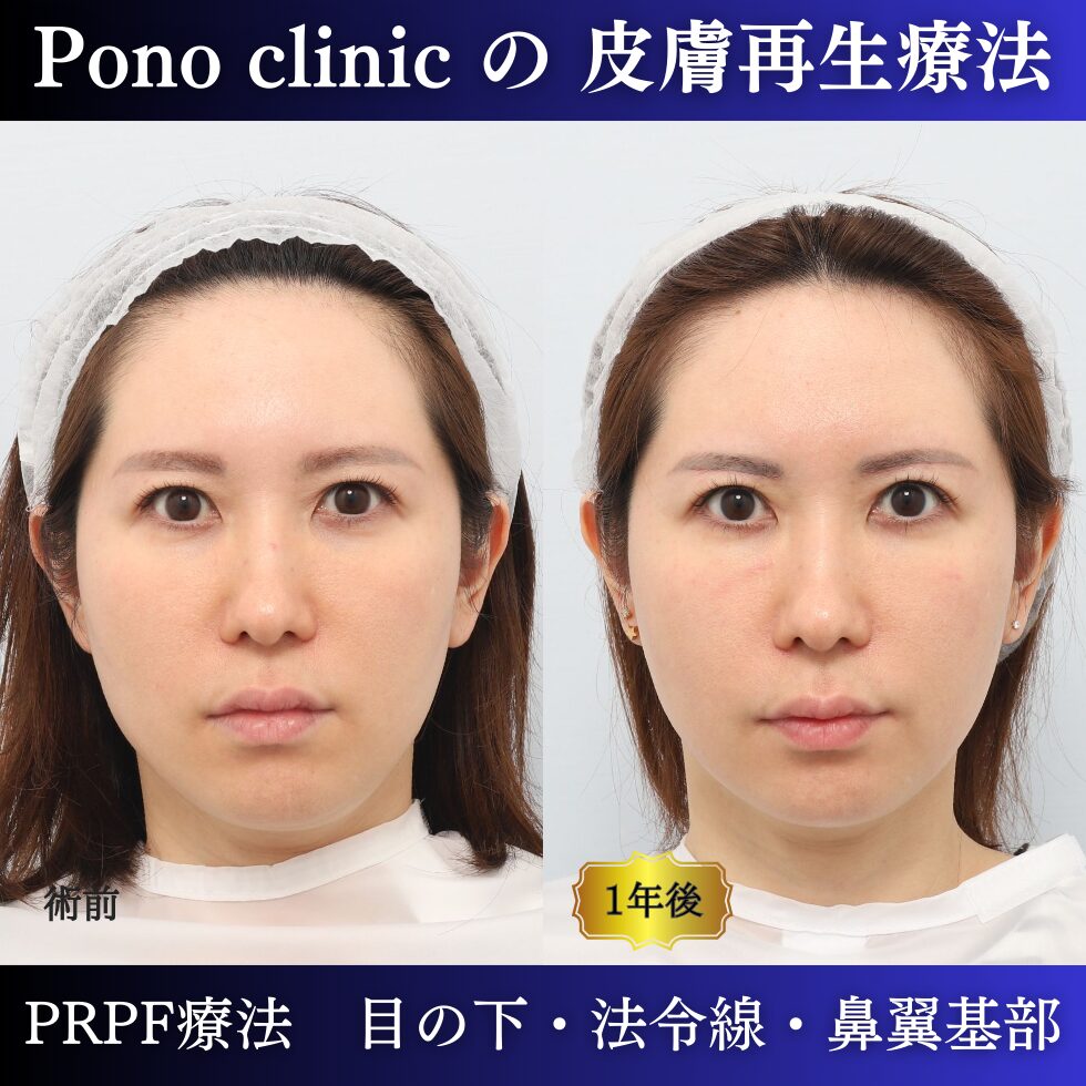 青クマ、法令線、鼻翼基部の凹み、PRPF®療法の症例