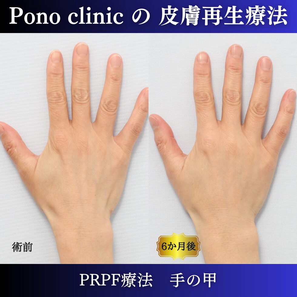 手の甲、若返り治療、PRPF 療法