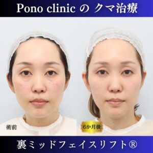 目の下のクマ取り、裏ハムラ、裏ミッドフェイスリフト、40代女性の症例1203