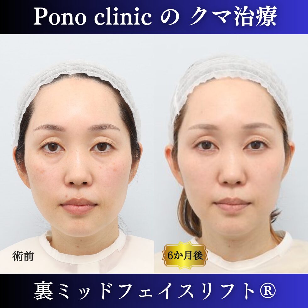 目の下のクマ取り、裏ハムラ、裏ミッドフェイスリフト、40代女性の症例1203