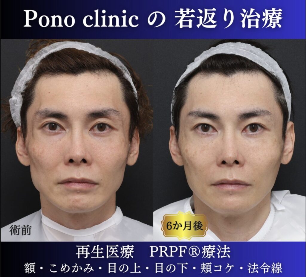 40代男性の症例、アンチエイジング治療、PRPF療法 (7)