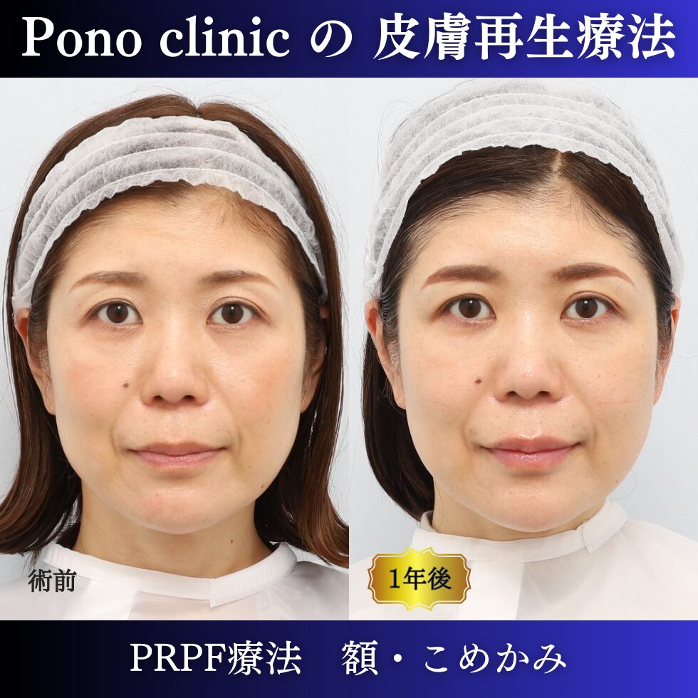 額、こめかみ、PRPF療法の症例