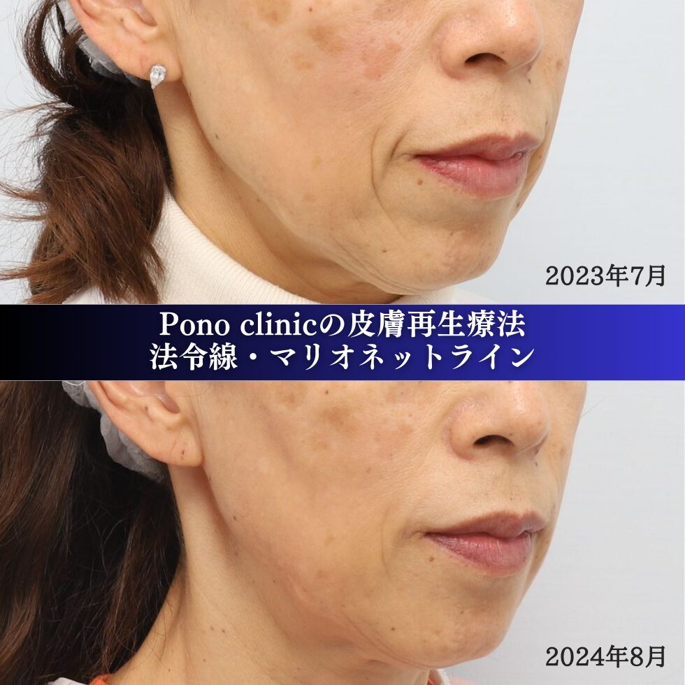 しわ取り、PRPF 療法、法令線、マリオネットライン、60代女性の症例
