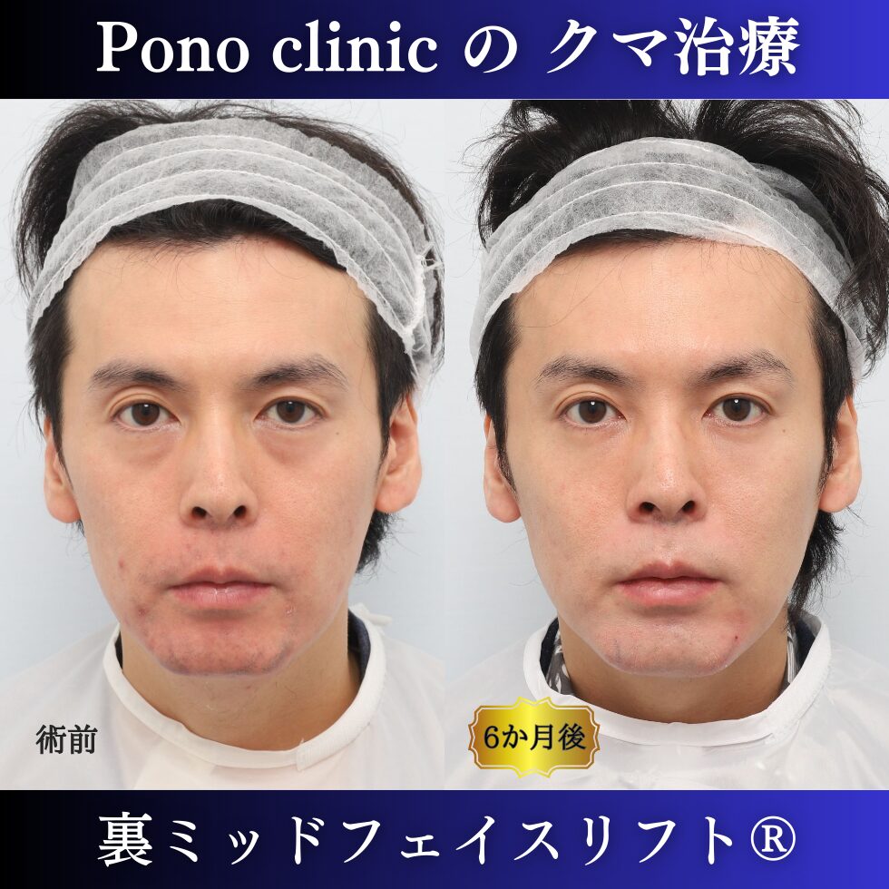 30代男性、クマ取り、裏ハムラ、裏ミッドフェイスリフトの症例