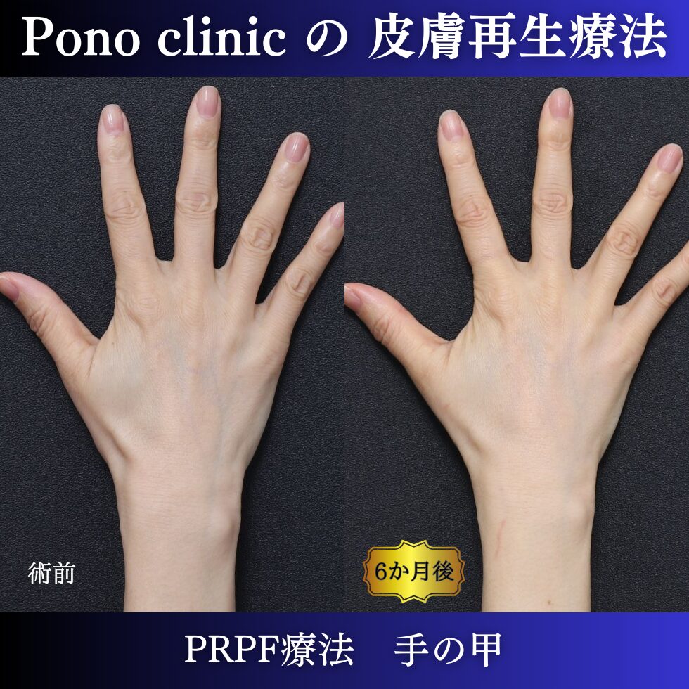 手の甲のアンチエイジング、PRPF療法、50代の症例