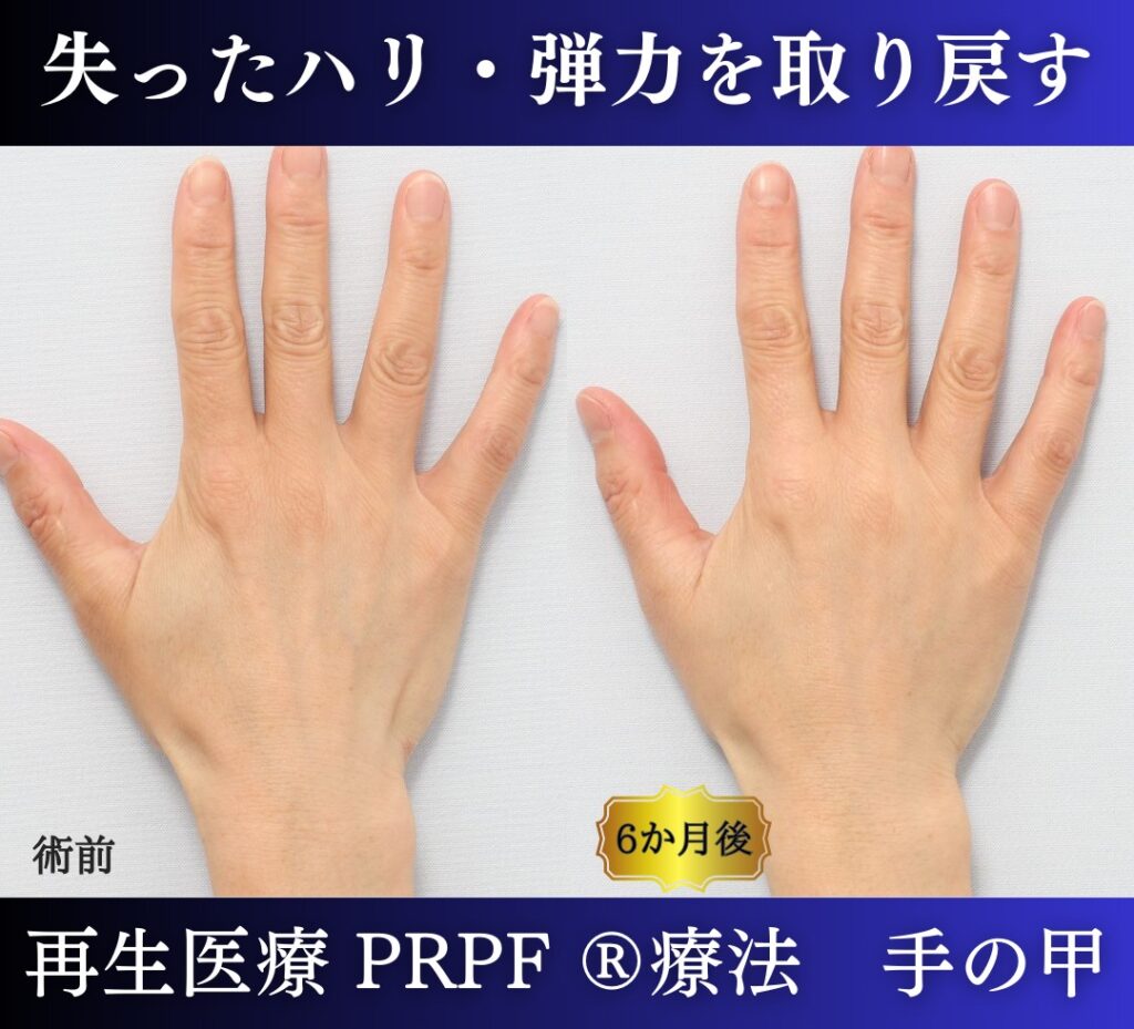 手の甲、若返り治療、PRPF 療法 (5)
