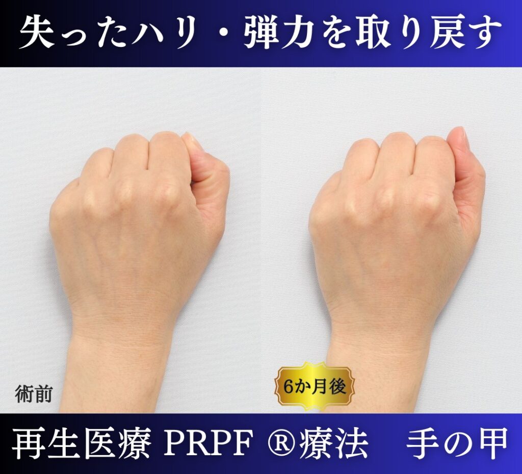 手の甲、若返り治療、PRPF 療法 (3)