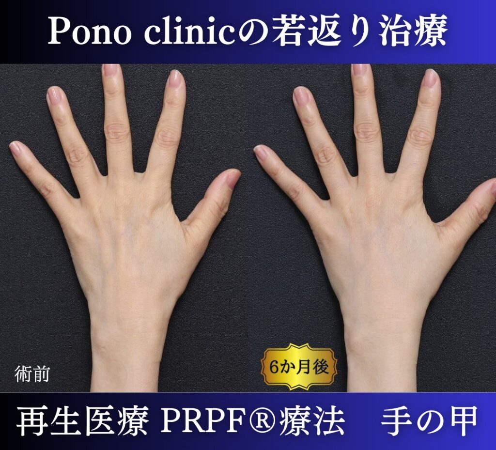 手の甲のアンチエイジング、PRPF療法、50代の症例 (3)