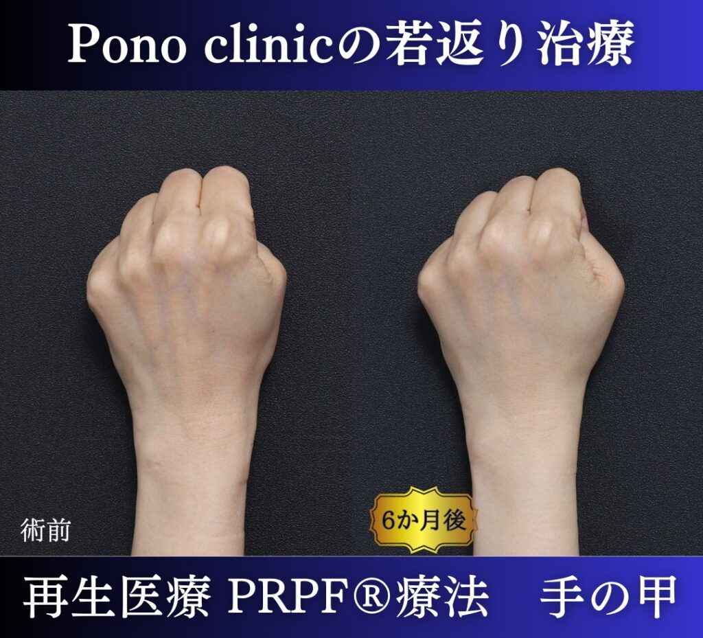 手の甲のアンチエイジング、PRPF療法、50代の症例 (2)