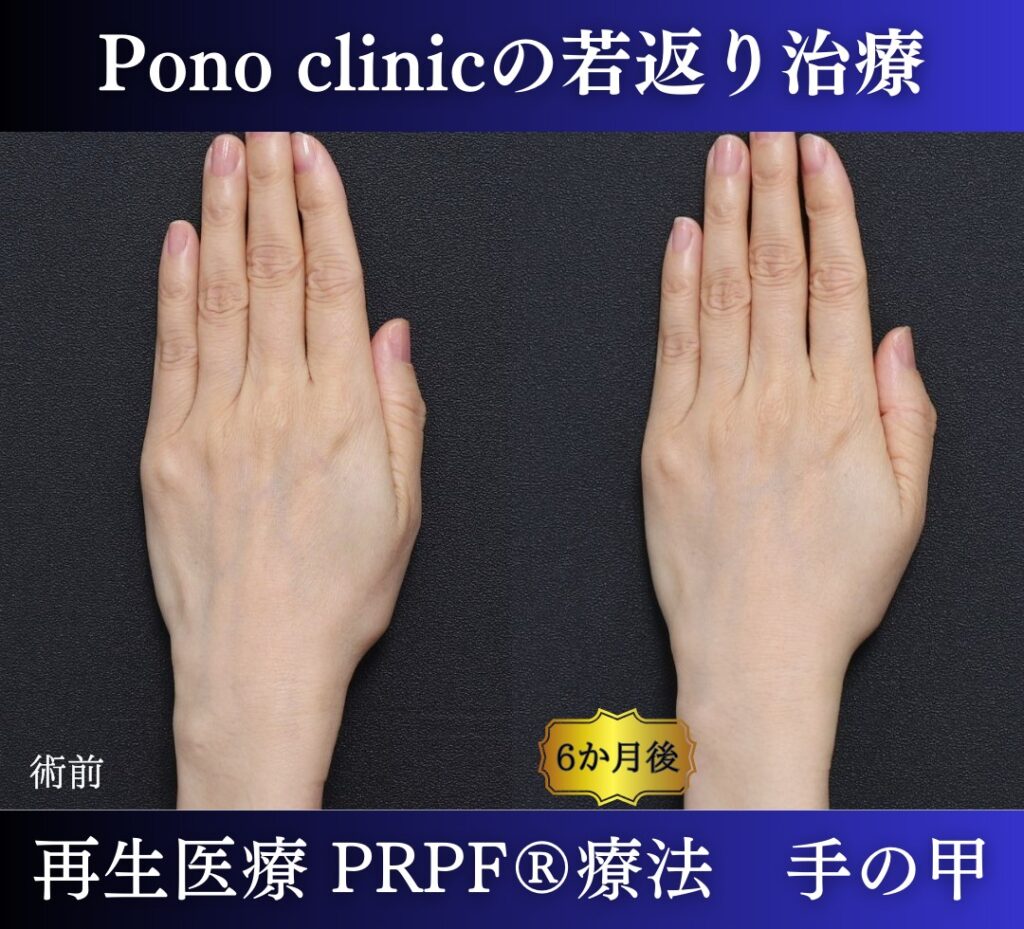 手の甲のアンチエイジング、PRPF療法、50代の症例 (4)