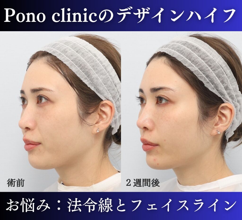 医療ハイフの症例、30代女性 (1)