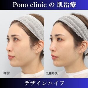 30代女性、ハイフ、リフトアップ、法令線治療の症例
