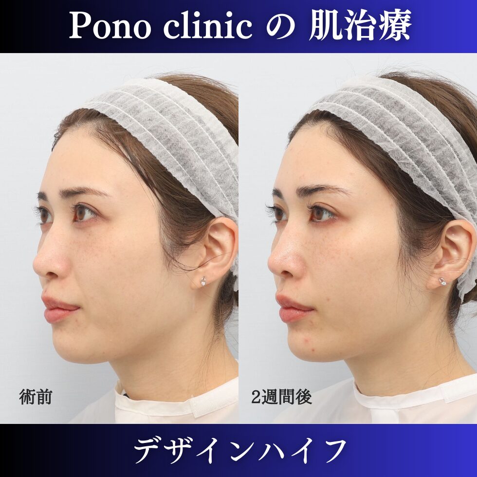 30代女性、ハイフ、リフトアップ、法令線治療の症例