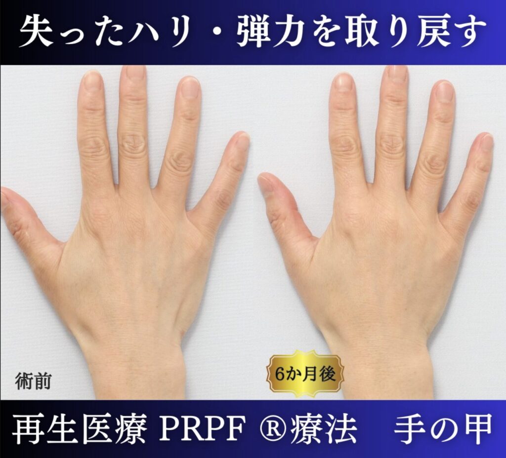 手の甲、若返り治療、PRPF 療法 (5)