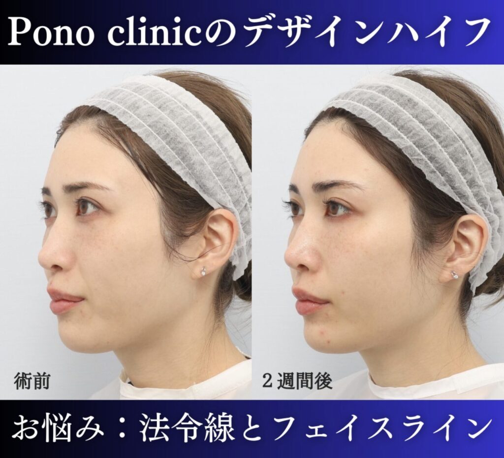 医療ハイフの症例、30代女性 (1)