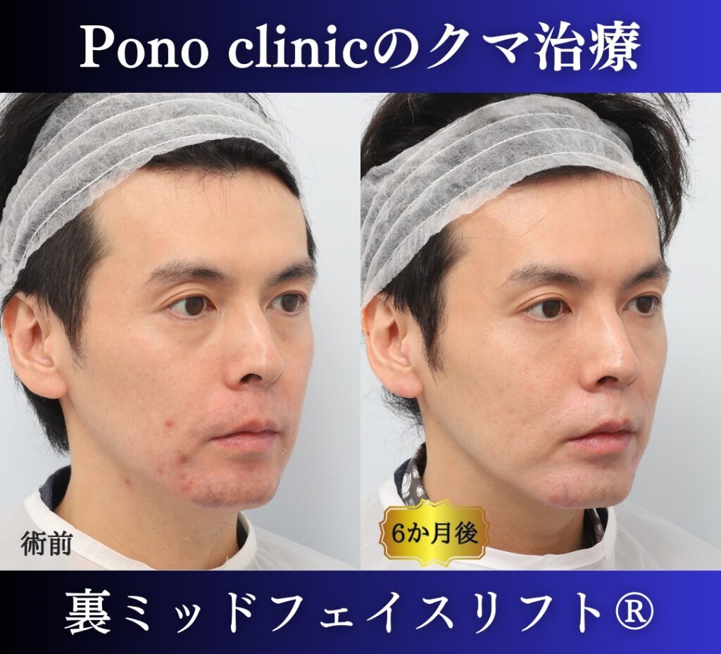 30代男性、クマ取り、裏ハムラの症例 (3)