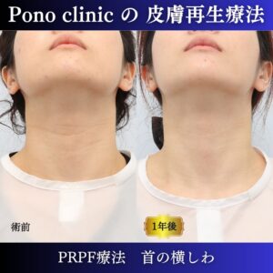 首の横しわ