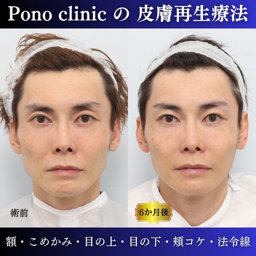 40代男性の症例、アンチエイジング治療、PRPF療法、しわ治療、目の下のクマ治療