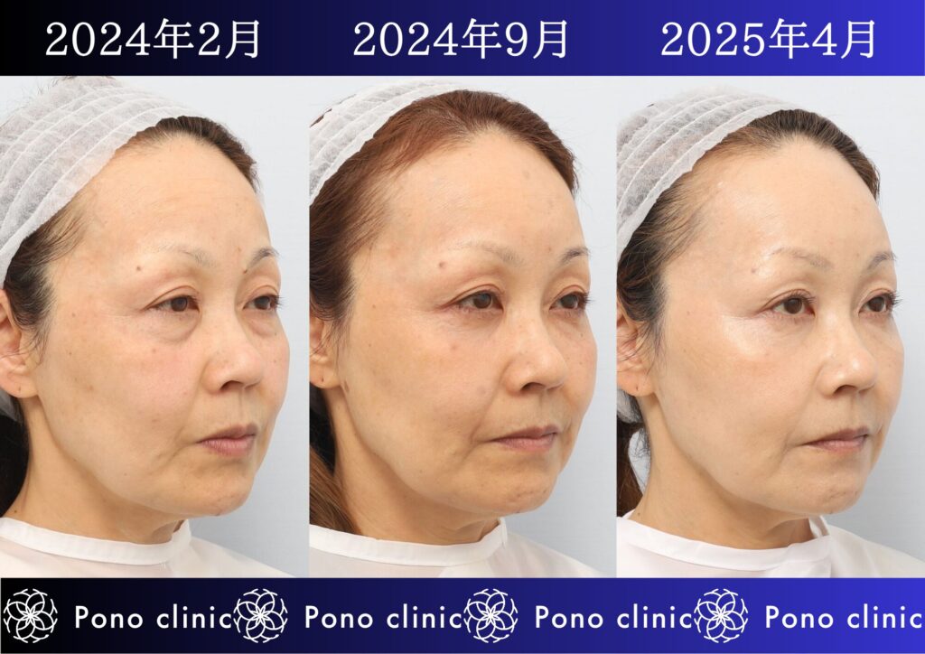 目の下のクマ治療、裏ミッドフェイスリフト®、PRPF®療法、50代の症例 (2)