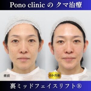 40代女性の症例、目の下のクマ取り、裏ミッドフェイスリフト