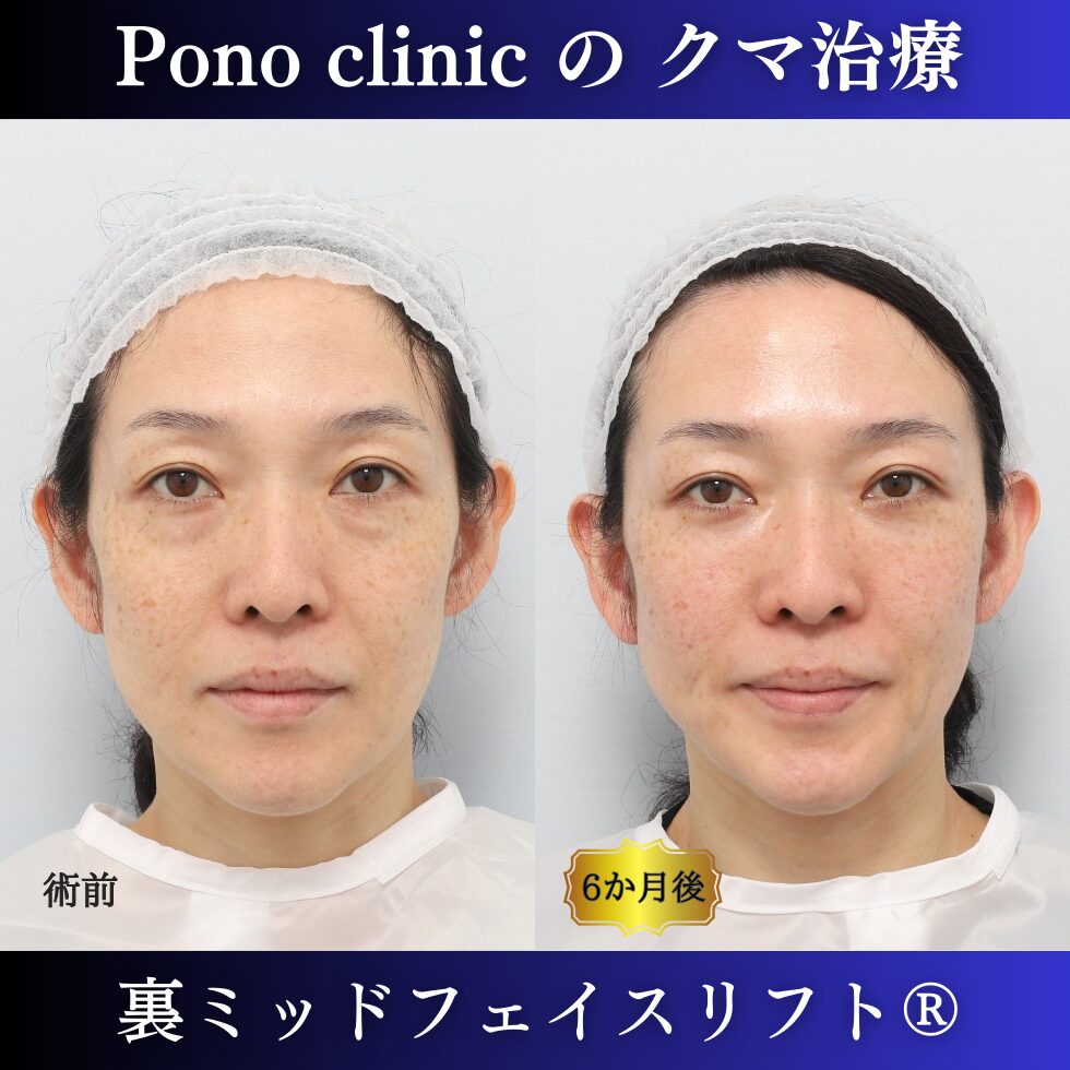 40代女性の症例、目の下のクマ取り、裏ミッドフェイスリフト