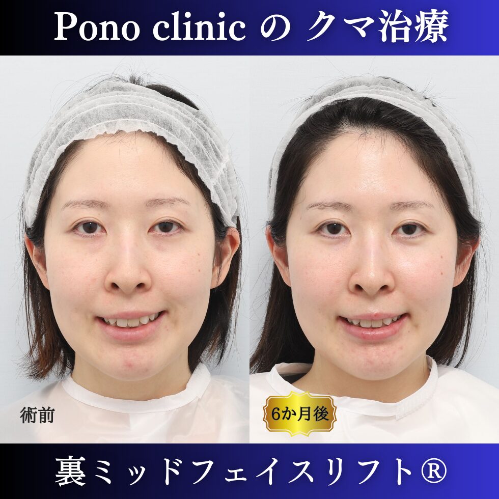 30代女性の症例、目の下のクマ取り、裏ミッドフェイスリフト、裏ハムラ