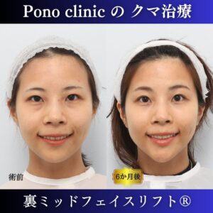 クマ取り手術、裏ミッドフェイスリフト、30代の症例