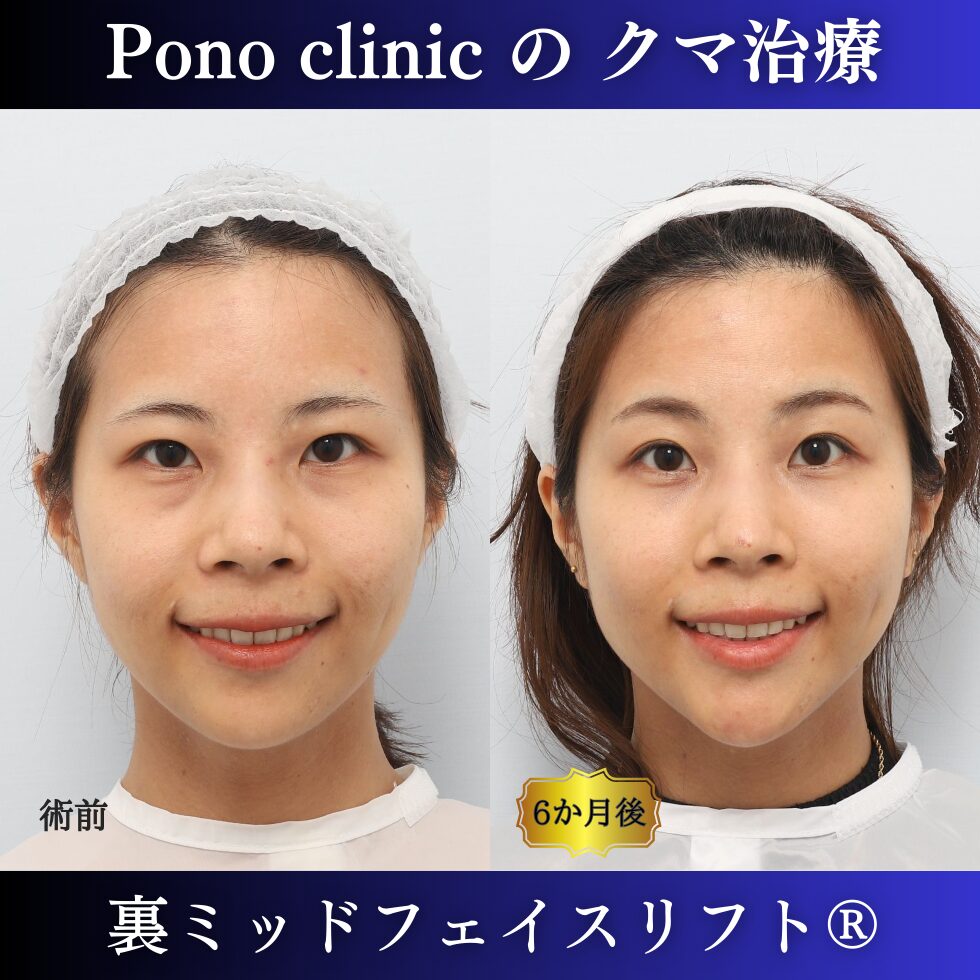 クマ取り手術、裏ミッドフェイスリフト、30代の症例