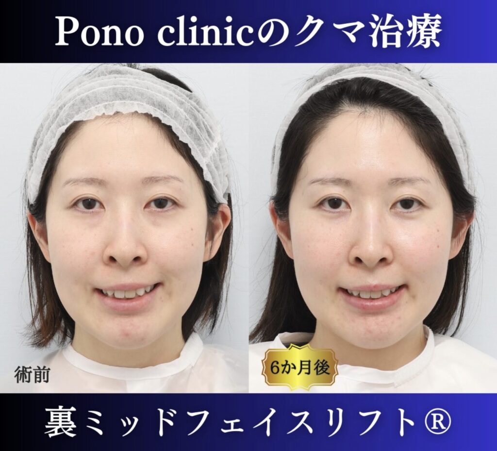 30代女性の症例、目の下のクマ取り (4)