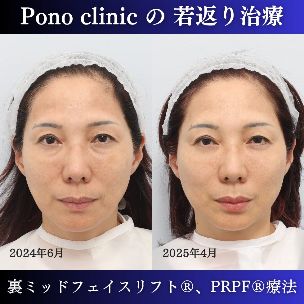 裏ミッドフェイスリフト、PRPF療法、50代の症例