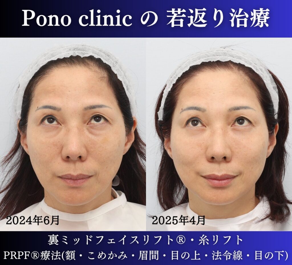 50代女性の症例、目の下のクマ、糸リフト、PRPF療法、若返り治療 (3)